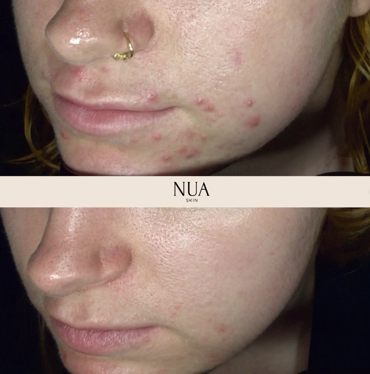 Client skin before and after treatment at Nua Skin, result 1