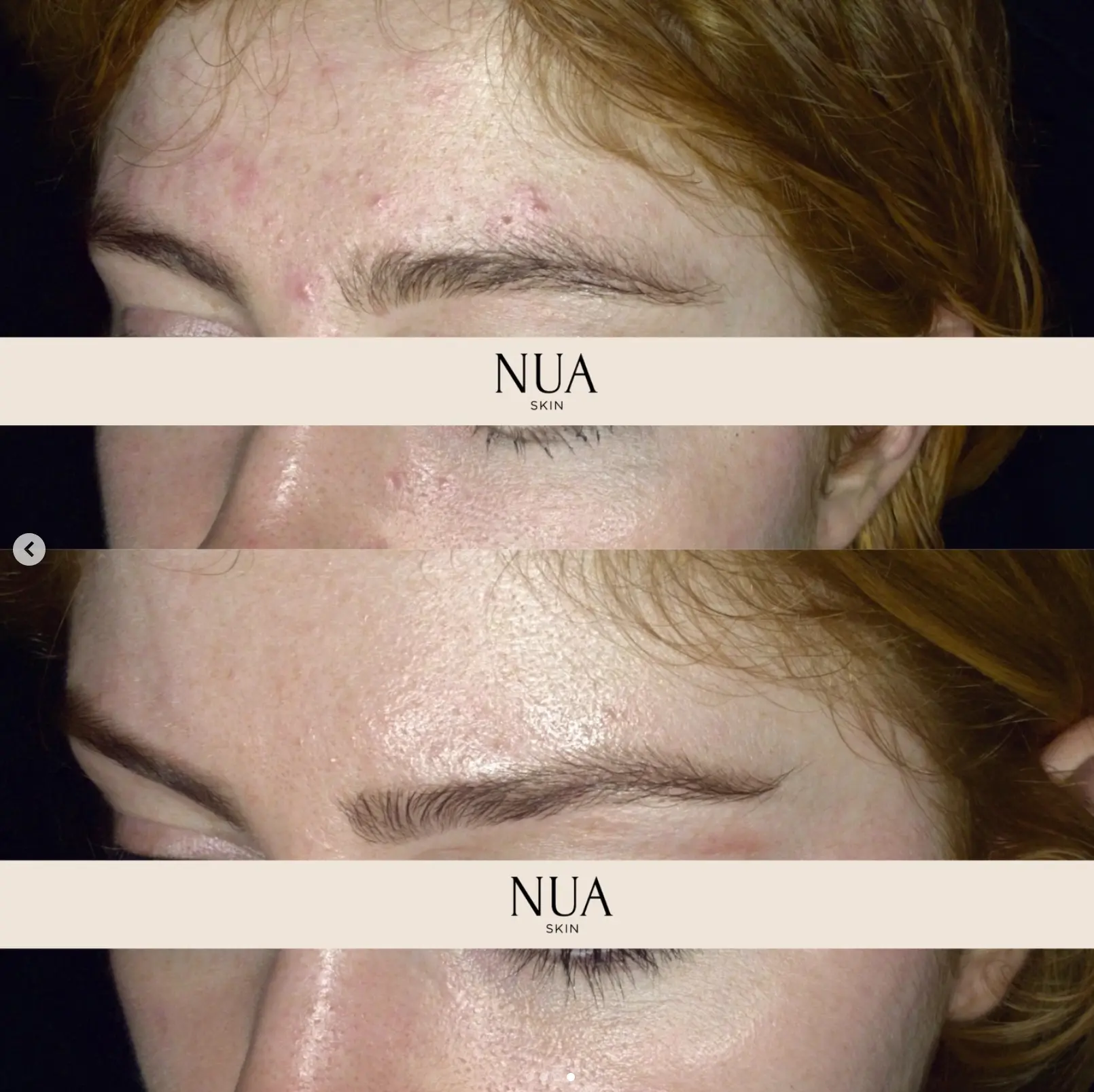 Client skin before and after treatment at Nua Skin, result 2