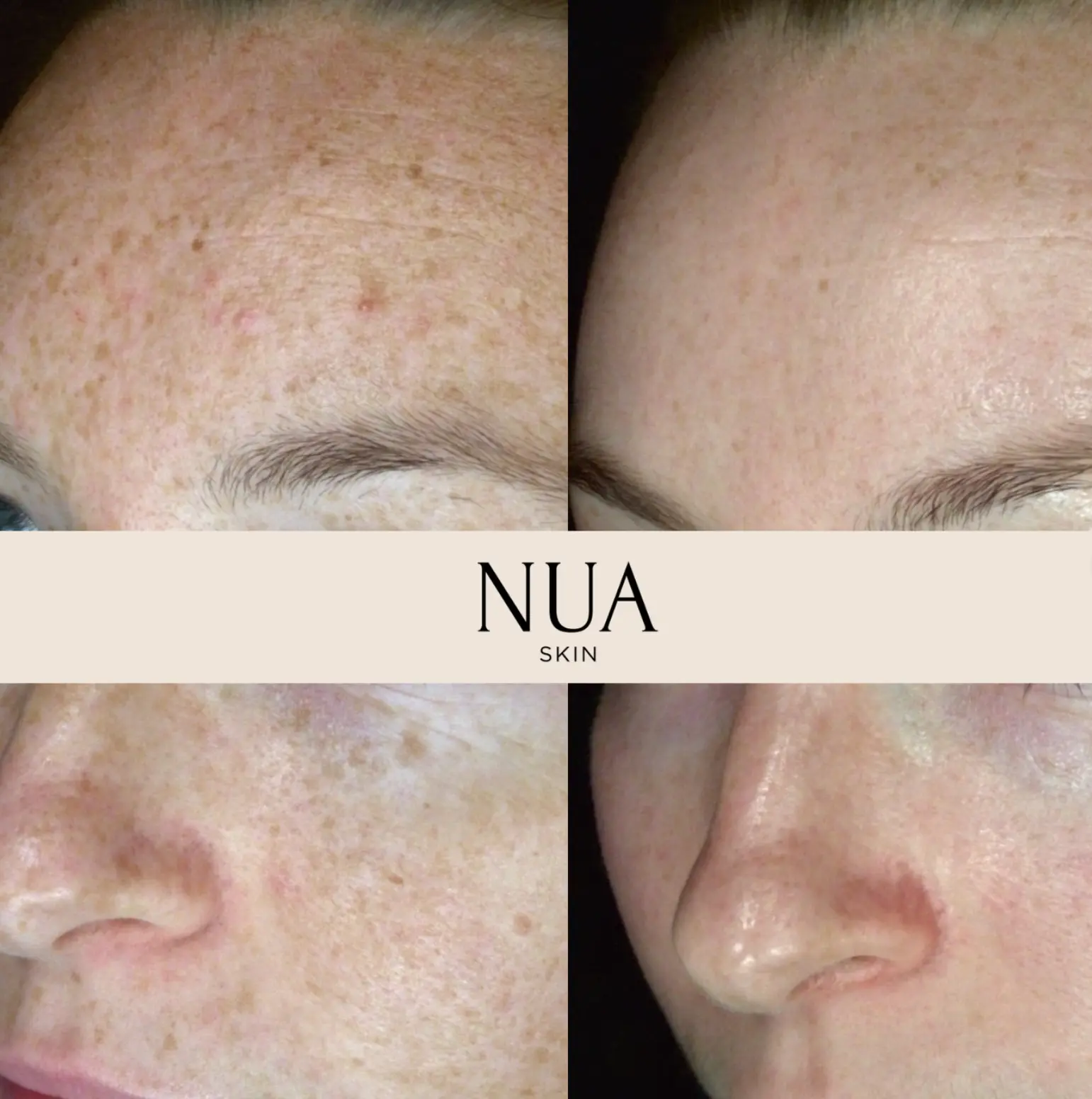 Client skin before and after treatment at Nua Skin, result 4